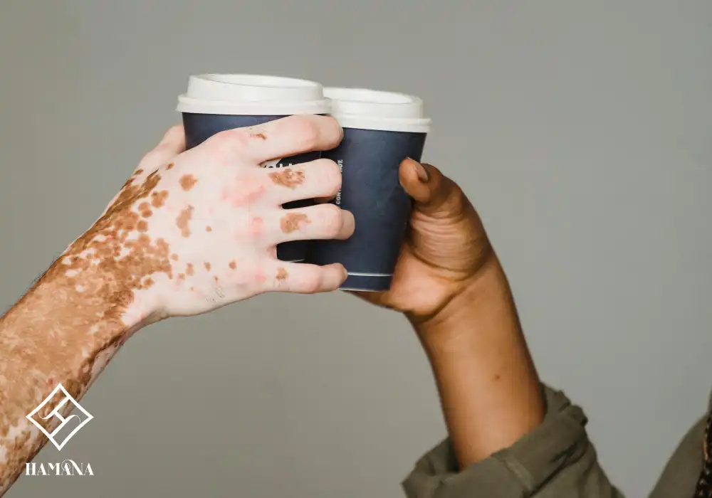 فواید نمک بدن و نمک حمام برای درمان پیسی (ویتیلیگو) دست با بیماری پیسی