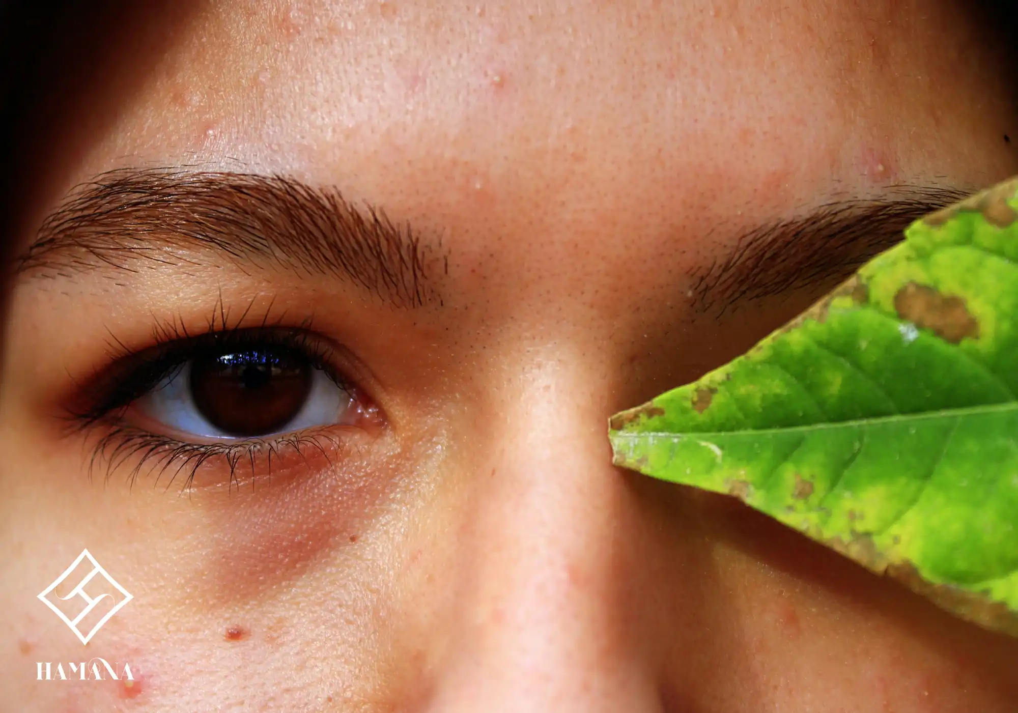 یک ص.رت دارای جوش و آکنه