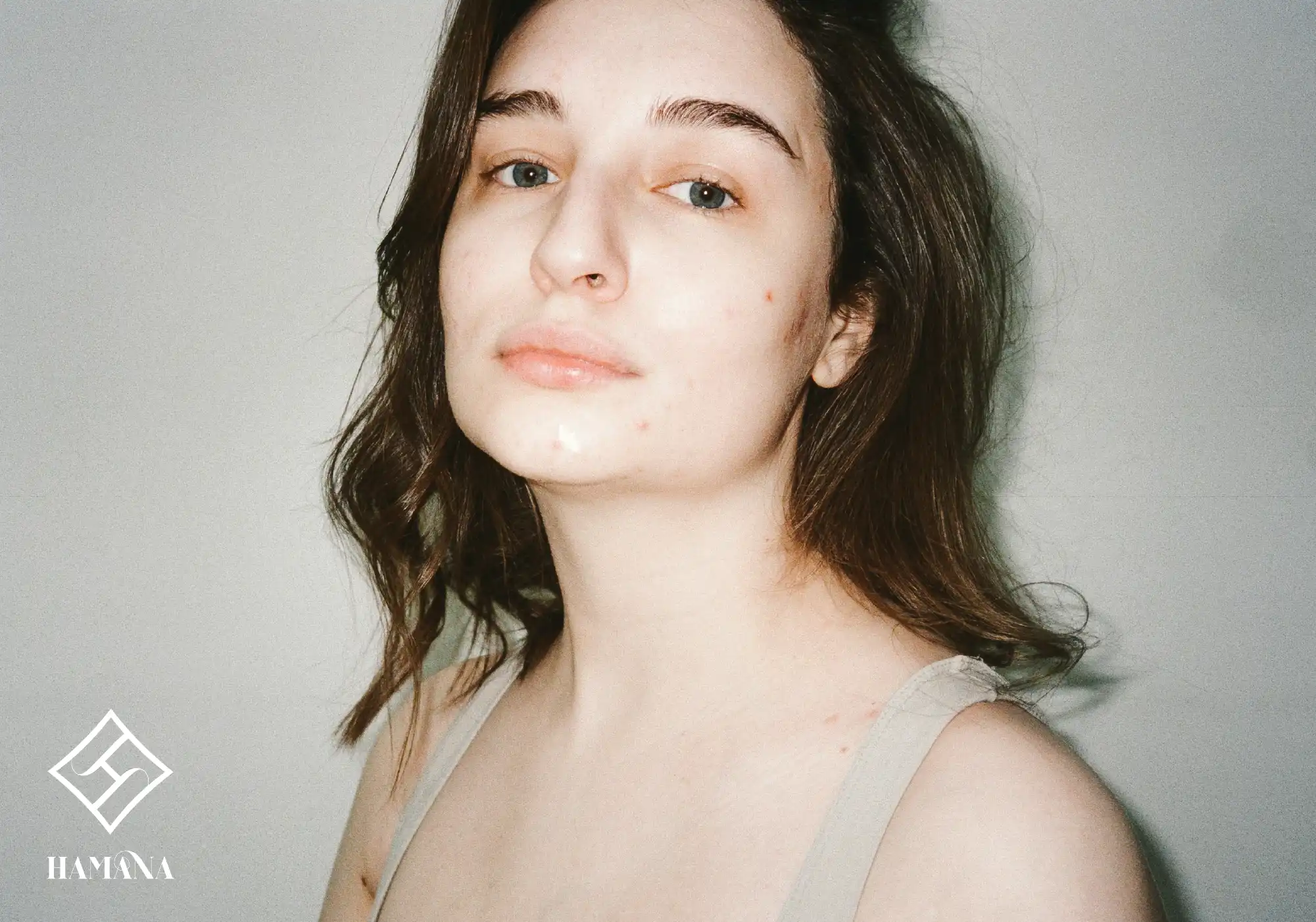 دختری دارای جوش و آکنه ی صورت