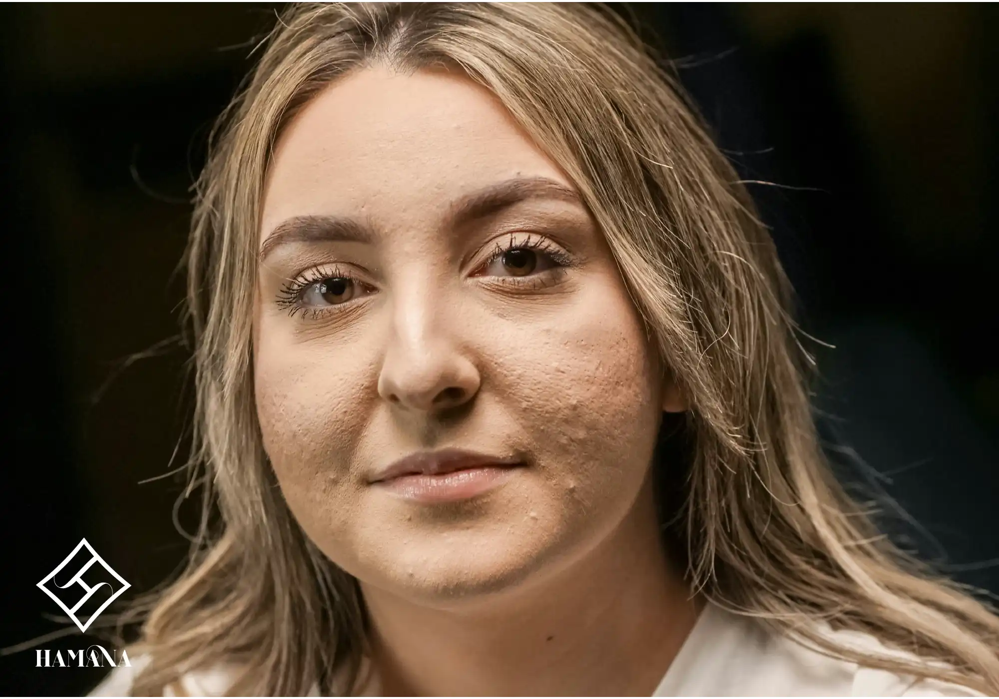 خانمی دارای جوش صورت