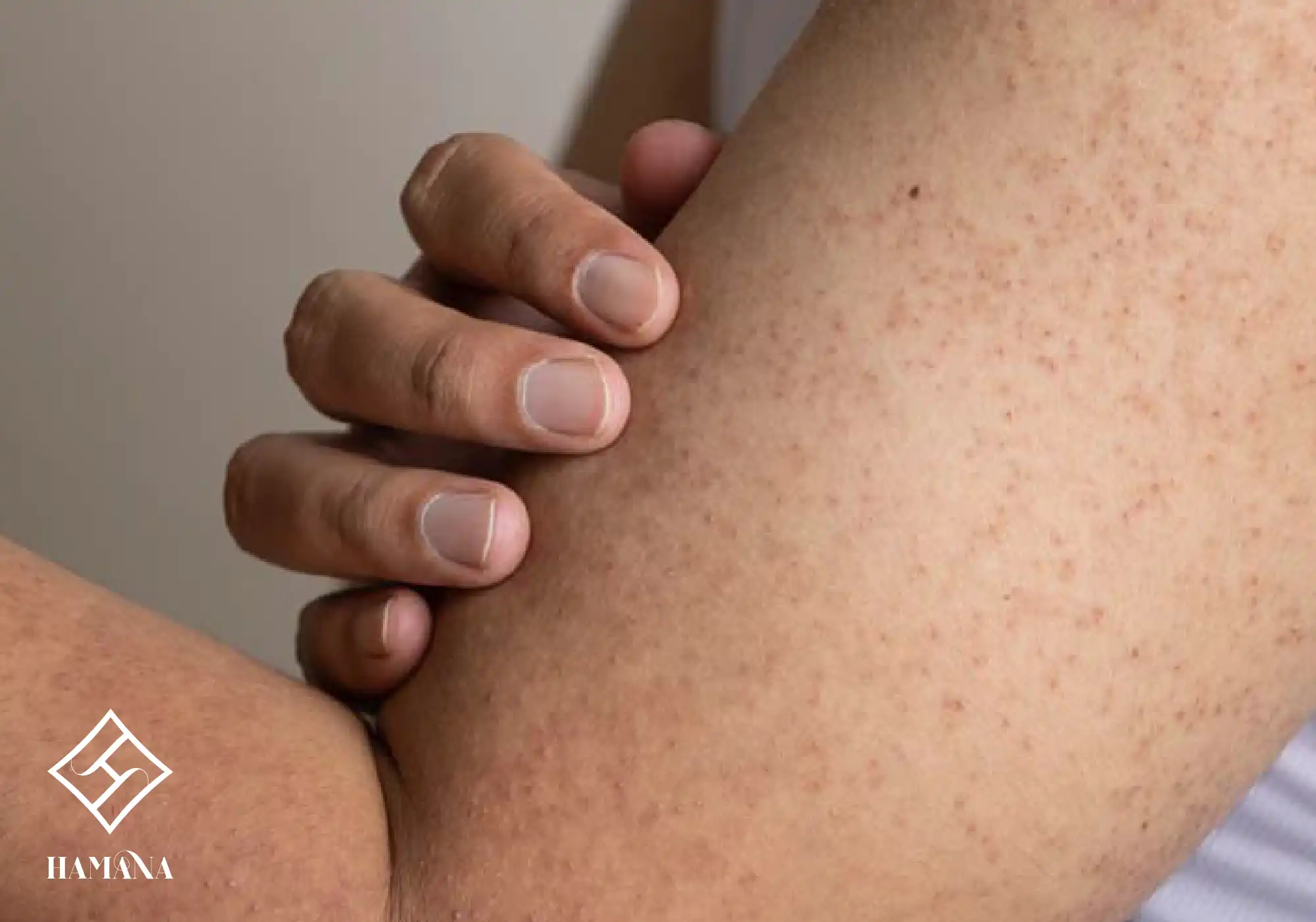 رفع پوست مرغی و کراتوز پیلاریس با نمک بدن و حمام | درمان طبیعی پوست مشکل پوست مری