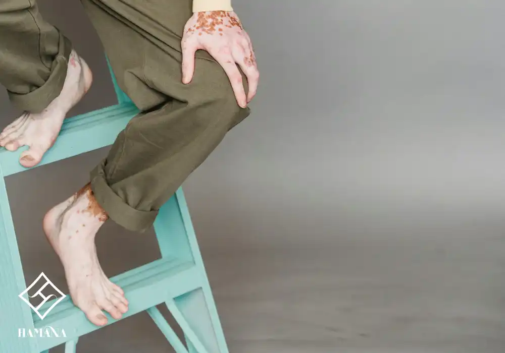 فواید نمک بدن و نمک حمام برای درمان پیسی (ویتیلیگو) دست با بیماری پوستی پیسی