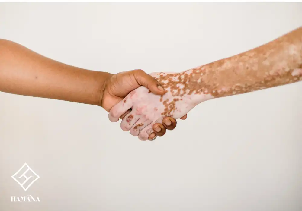 دست با بیماری پوستی پیی