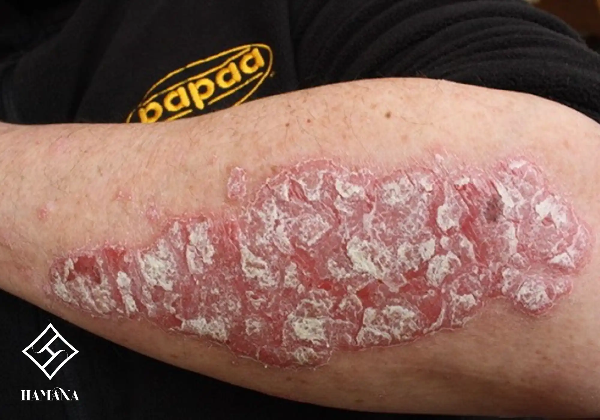 فواید نمک بدن و نمک حمام برای درمان پسوریازیس پوستی با بیماری پسوزیاریس