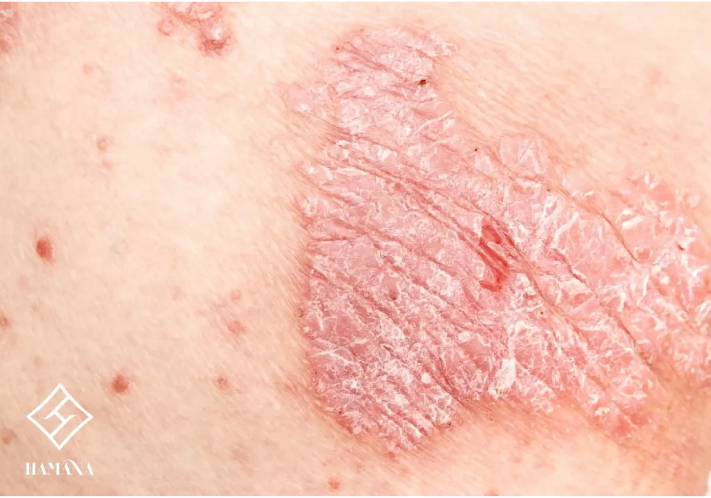 پوستی با بیماری پسوزیاریس