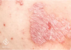 پوستی با بیماری پسوزیاریس