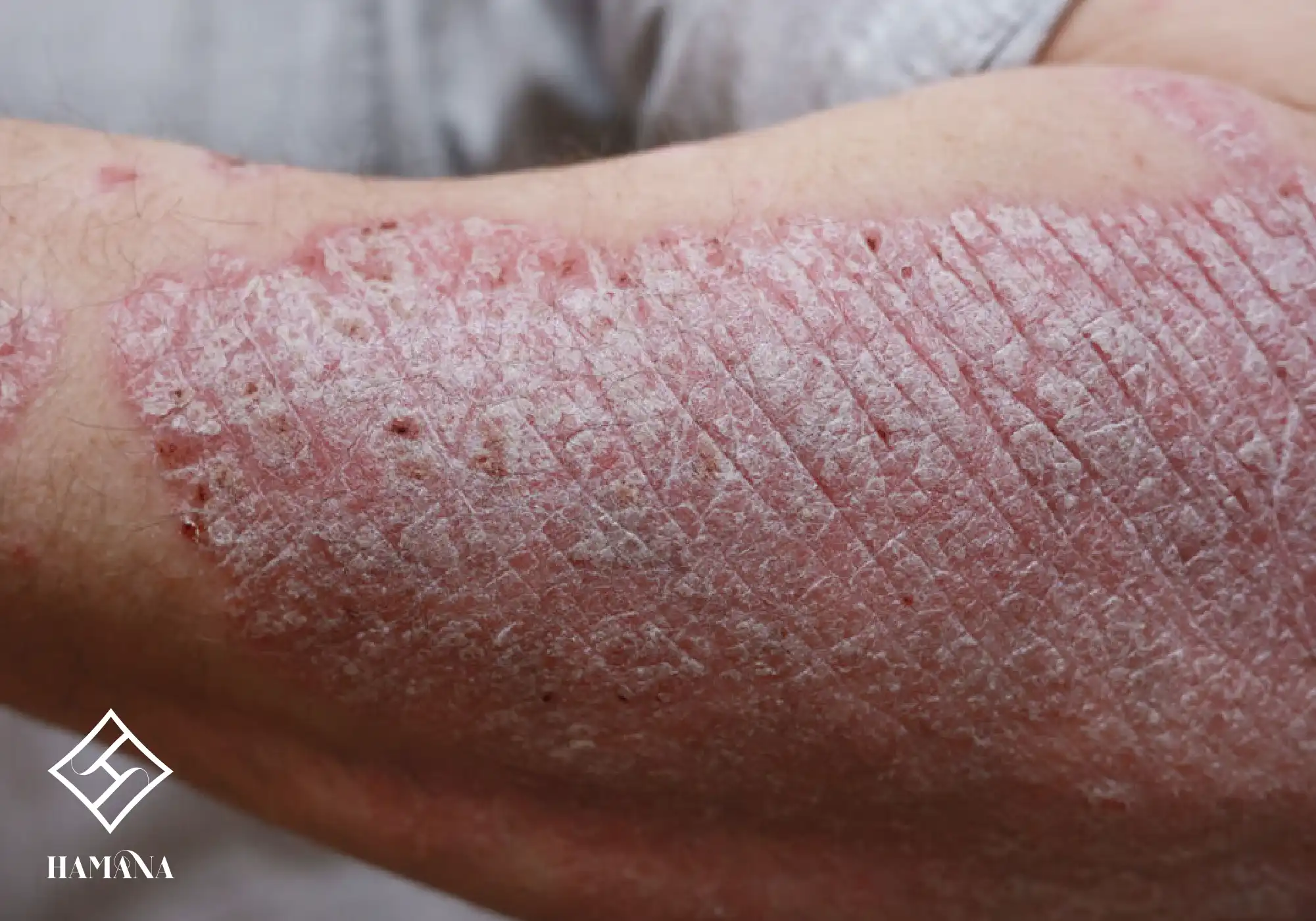 فواید نمک بدن و نمک حمام برای درمان پسوریازیس پوستی با بیماری پسوزیاریس