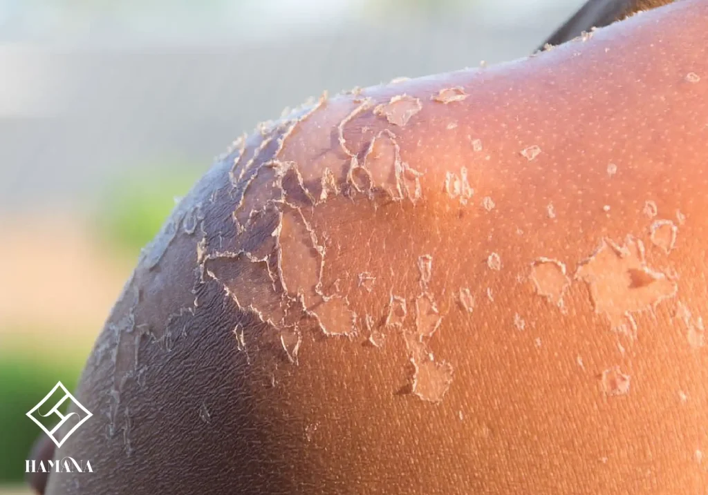 کنده شدن پوست در اثر آفتاب سوختگی