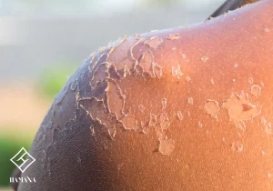 کنده شدن پوست در اثر آفتاب سوختگی