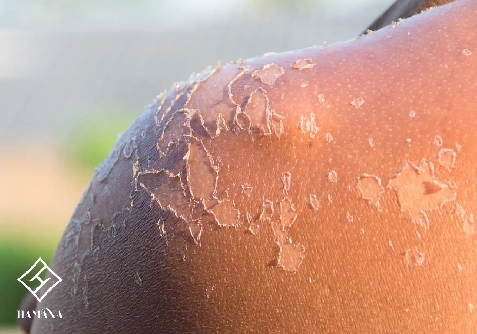 کنده شدن پوست در اثر آفتاب سوختگی