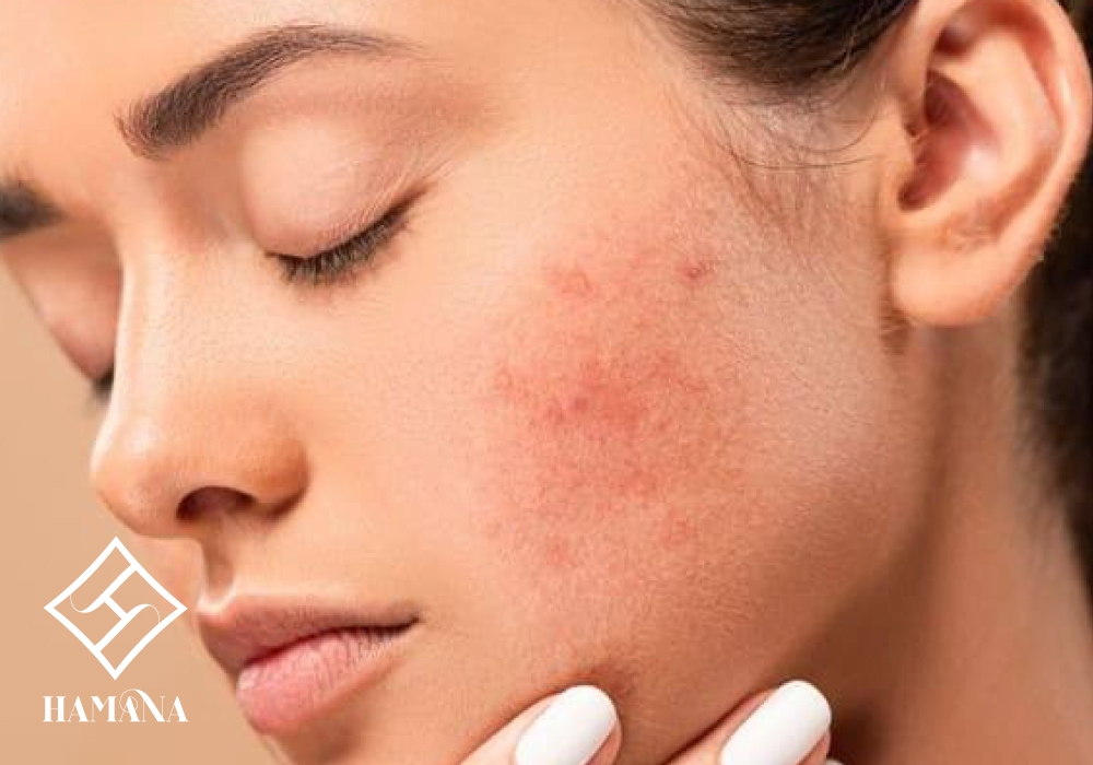 جوش هورمونی چیست و چگونه کنترل میشود؟ جوش هورمونی