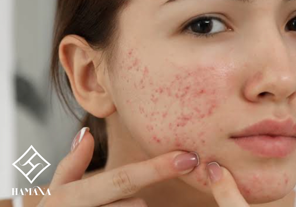 جوش هورمونی چیست و چگونه کنترل میشود؟ جوش هورمونیجوش هورمونی