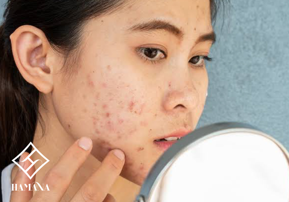جوش هورمونی چیست و چگونه کنترل میشود؟ جوش هورمونی